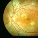 Central Serous Chorioretinopathy 3